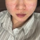 누가한의원 | 노원 여드름흉터 한의원에서 통증없는 새살침 여드름패인흉터치료 후기