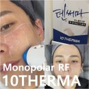 강남-251 | 강남 피부과 추천 고현정 리프팅 텐써마 효과 솔직 후기!