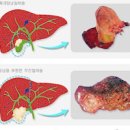 담낭암 담낭암 원인 증상 치료 담낭암 발견이 늦은 이유 쓸개암 담낭암 생존율 이미지