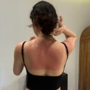 태양약국 | 발리 태양 무섭다…썬번 1도&amp;2도 화상 후기｜멘장안 스노클링 후 등 화상 + 가디언 알로에젤