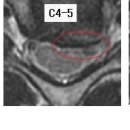 소마님의 경추디스크, 흉추디스크 MRI사진 판독입니다. 이미지