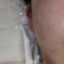 대티로 | 부산에스테틱 메디온스킨 여드름 압출 &amp; 장벽 관리 후기