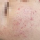 록에스테틱 | 울산 록에스테틱 여드름 압출 & 맞춤 관리 후기