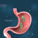 만성표재성 위염 너무 흔하지만 치료와 예방은 확실하게 이미지