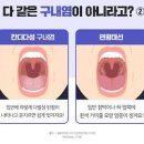 장마철 &#39;구내염&#39; 전염 주의 통증, 작열감, 불편함 등 다양한 증상 유발 이미지