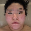 번화1로 | 김해 장유 에스테틱 문제성 여드름 피부관리｜엘리유스킨 전후 후기