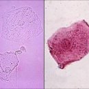 요침사 - 소변에서 볼수있는 여러가지 세포 이미지