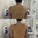 힐링메디칼 | 힐링피부연구소 | 꼼꼼하고 효과좋은 화곡동 에스테틱에서 등관리 받은 후기