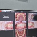 아이디마곡치과교정과치과의원 | 마곡아이디치과 부분교정 8개월만에 완료 후기 (철사 유지장치 비용 별도)