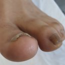 너무아픈 화성무좀발톱 내성발톱 고민 해결해주는 레푸스향남점