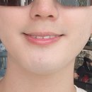 마곡 레이저제모 후기 남자수염제모 가격 효과 통증 내돈내산 5회차 전후