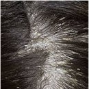 지루성 피부염[Seborrheric dermatitis]피부질환 이미지