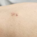 연세 제이원의원 | 시술 3주 경과 / 지방종 시술 보험사 필요 서류/ 상처 아문 정도/대전 연세화사외과 /총 6회 방문/흉터