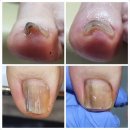 지인더네일 | 의정부 파고드는 내성발톱 더케어 네일앤스파 관리 후기
