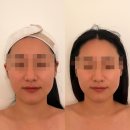 온앤유에스테틱 | 대구웨딩관리 추천 온앤유에스테틱 3V윤곽테라피 후기