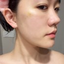 비올라셀성형외과의원 | 신사역 실리프팅 내돈내산 후기 :: 비올라셀성형외과 일주일차 솔직 후기