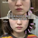 손꾹꾹 관리샵 | 천안 신부동피부관리 비대칭 얼굴 헤리티지 턱선 윤곽관리 2회차 후기 아인피부체형전문샵