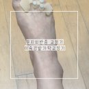수송로 | 무지외반증 교정기 효과 이숙경발가락교정기 엄지 교정후기
