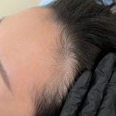 란헤어라인 - 창원시 마산회원구 합성시장길 40 | 강남 다롬 SMP/ 자연스러운 이마 헤어라인 두피문신 시술 후기
