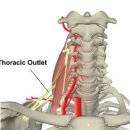 흉곽출구 증후군 이미지