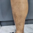 편안하지흉부외과 하지정맥류수술