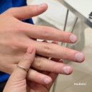 인천 물어뜯는손톱 문제성손톱 메디푸스 한달반 후기(조갑박리증, 조갑주위염)