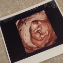 [이대목동병원 허영민 교수님] 임산부 홍순이👶 초음파/ 마미렉틴 입덧약 / 기형아검사