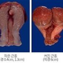 자궁근종 원인 증상 크기 낫는법 예방 이미지