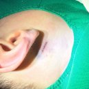 유피성형외과의원 | 아기 낭종 모반 제거 수술 후기 비용 가격 정보