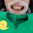 이현섭의원 | 신사역5번출구앞 "서울센텀치과" 내돈내산 치아미백 시술후기