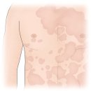 탈락 피부염[Exfoliative dermatitis]피부질환 이미지