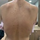 미강빌딩 | 리유한의원 강남본점 등드름 미강약침 치료 가격 내돈내산 후기