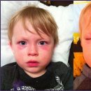 알레르기 이미지