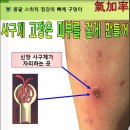 신장 사구체가 고장이 나면~~ 이미지