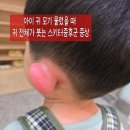 민준약국 | [공지] [아이 귀 모기 물렸을 때] 모기 알레르기 스키터증후군 증상 및 소아과 진료후기