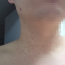 늘푸른피부과의원 네이버블로그
