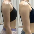 신의의원 | [2회차 후기] 상상 하던 라인 나오는 중..? 지방분해주사의원 솔직 변화 기록✨