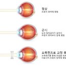 목동 오목교 남학생 근시 억제 렌즈 안경 맞춤 후기 / 목동 안경백서