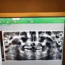 원광대학교치과대학산본치과병원 | 선우 과잉치 발치 수술