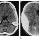 경막외 출혈[epidural hemorrhage]질환이란? 이미지