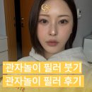 골드제이의원 | 관자놀이 필러 붓기 부작용 전후 후기 통증은 어느 정도일까?