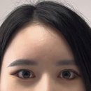 시그널성형외과의원 | [부산 이마 실리프팅] 시술방법,부작용,유지기간,후기가 궁금하다면?