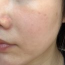 오오피부과의원 | 압구정피부과 엑셀브이 레이저시술 후기, 기미 색소 잡티 개선