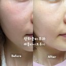 후 | 광화문피부과 레블라이트 토닝 일주일 후 후기