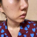 쉿!! 나혼자 쓰는 여드름 스킨케어! (피부과x) 여드름화장품 추천 이미지