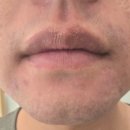 자동차피부과 | 광주 레이저제모 봉선동 피부과 젠틀맥스프로 후기