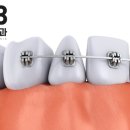 아산제일치과의원 | 아산치아교정 잘하는 곳은 어떻게 찾을 수 있나요?