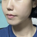 양산에너지 | 양산피부과 올리지오후기 내돈내산 300샷