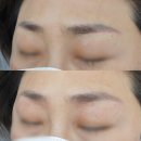 배곧 눈썹문신제거 통증, 많이 아픈가요? | 제거후 관리방법과 제대로된 후기 궁금해요 (시흥 안산)