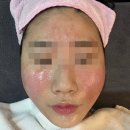 센스필빌딩 | 서울 강남 신논현역 여드름 압출 피부관리 보름달뷰티 좁쌀여드름 압출 블랙필 관리 후기